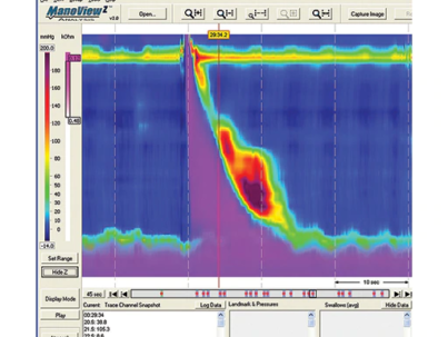 manoscan-eso-software-normal-swallow-p